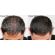 HairMax LaserBand 82 - ComfortFlex LASER THERAPY FOR HAIR REGROWTH, rose gold (16970-rose-gold)