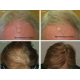 HairMax LaserCap 272 PowerFlex – Laser Hair Growth Cap (LASER 272)