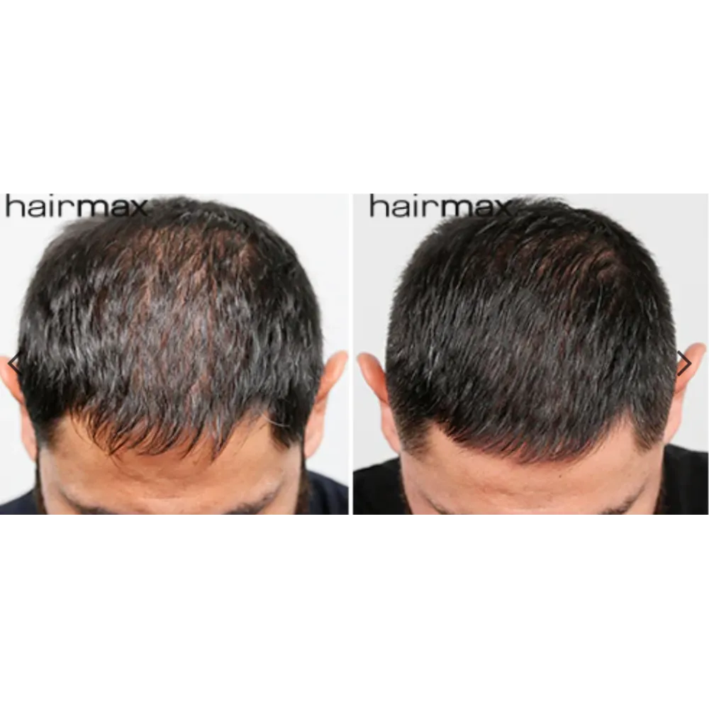 HairMax LaserBand 82 - ComfortFlex LASER THERAPY FOR HAIR REGROWTH, rose gold