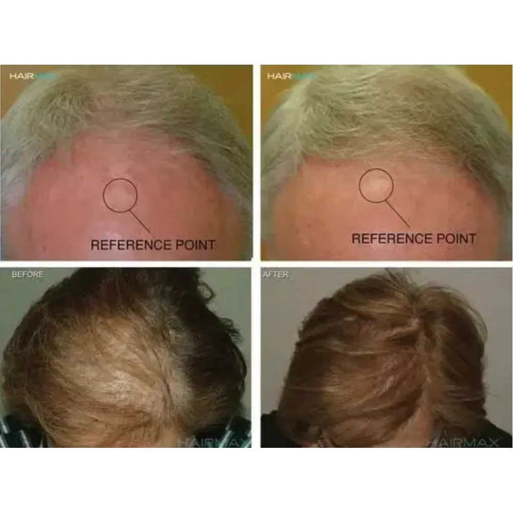 HairMax LaserCap 272 PowerFlex – Laser Hair Growth Cap