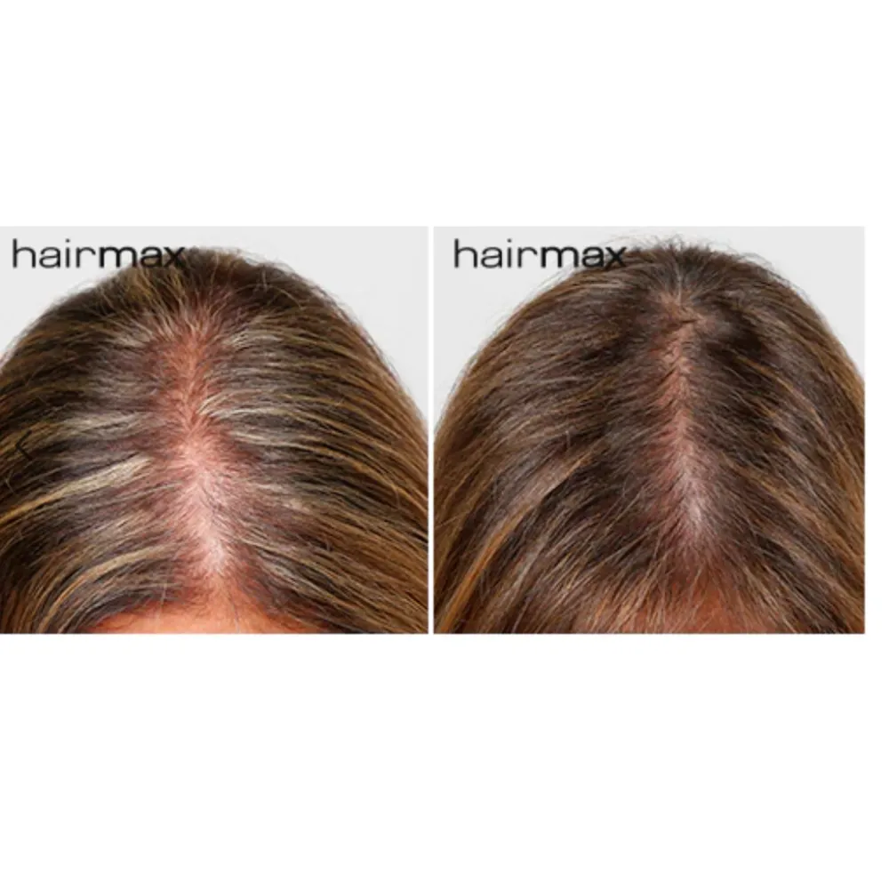 HairMax LaserBand 82 - ComfortFlex LASER THERAPY FOR HAIR REGROWTH, rose gold